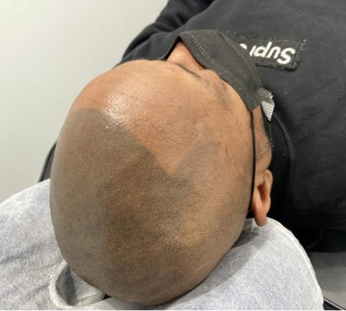 scalp micropigmentation for thinning hair